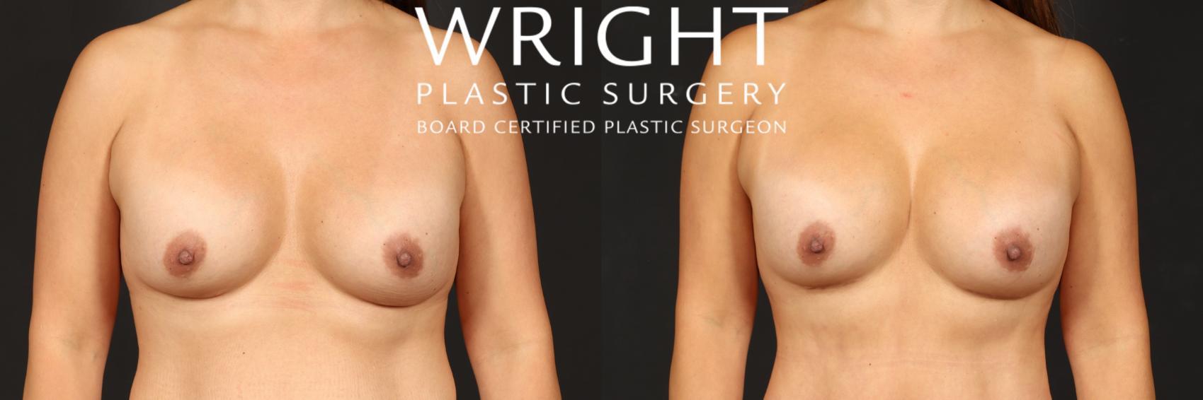 Before & After Breast Implant Exchange Case 555 Front View in Little Rock, Arkansas