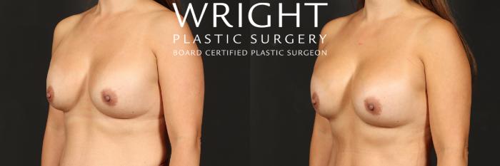 Before & After Breast Implant Exchange Case 555 Left Oblique View in Little Rock, Arkansas