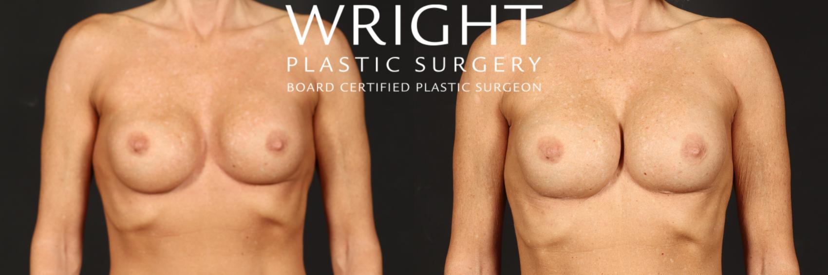 Before & After Breast Implant Exchange Case 567 Front View in Little Rock, Arkansas