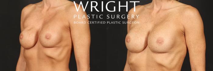 Before & After Breast Implant Exchange Case 567 Left Oblique View in Little Rock, Arkansas