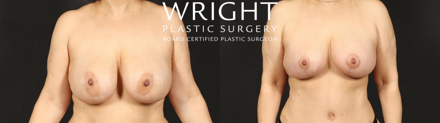 Before & After Breast Implant Exchange Case 610 Front View in Little Rock, Arkansas