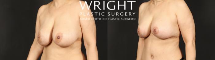 Before & After Breast Implant Exchange Case 610 Left Oblique View in Little Rock, Arkansas
