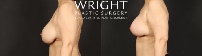 Before & After Breast Implant Exchange Case 610 Left Side View in Little Rock, Arkansas