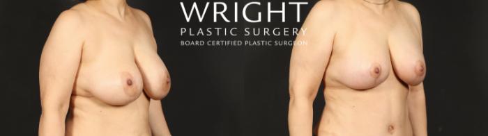 Before & After Breast Implant Exchange Case 610 Right Oblique View in Little Rock, Arkansas