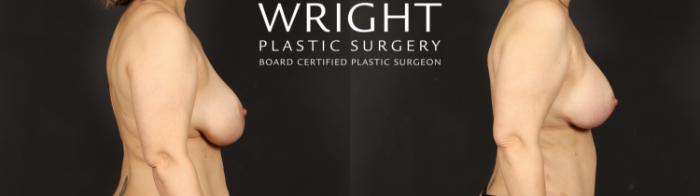Before & After Breast Implant Exchange Case 610 Right Side View in Little Rock, Arkansas