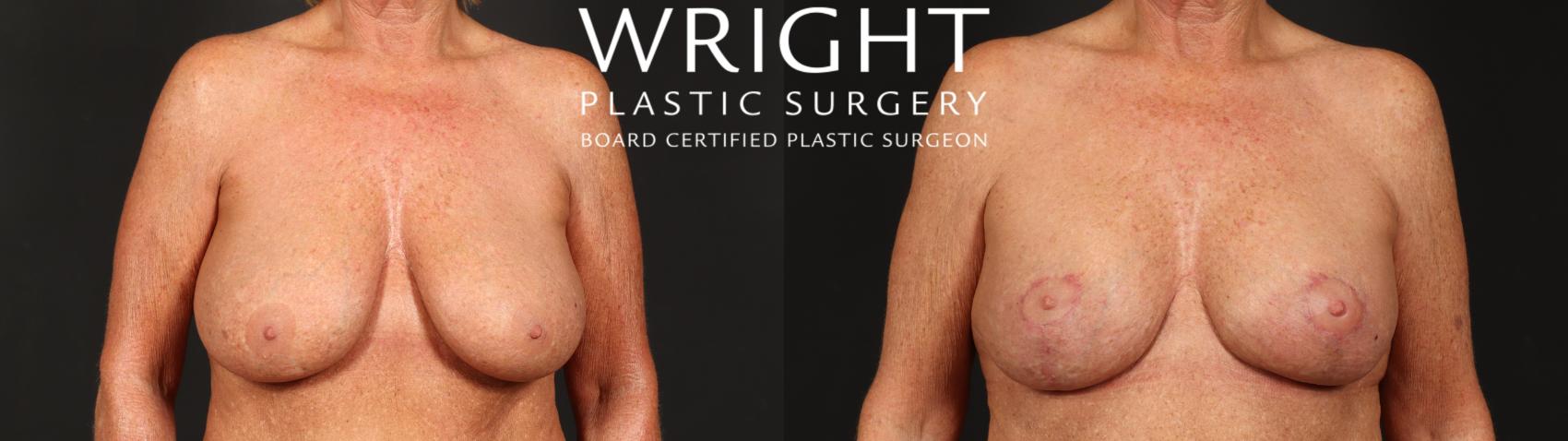Before & After Breast Implant Exchange Case 641 Front View in Little Rock, Arkansas