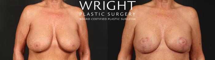Before & After Breast Implant Exchange Case 641 Front View in Little Rock, Arkansas