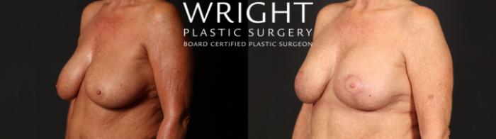Before & After Breast Implant Exchange Case 641 Left Oblique View in Little Rock, Arkansas