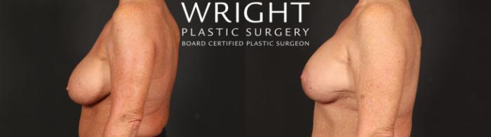 Before & After Breast Implant Exchange Case 641 Left Side View in Little Rock, Arkansas