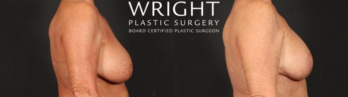 Before & After Breast Implant Exchange Case 641 Right Side View in Little Rock, Arkansas