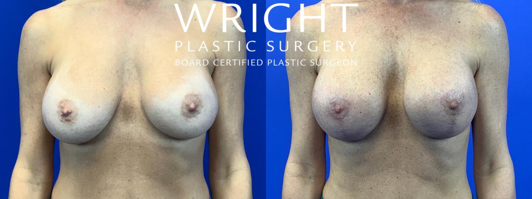 Before & After Breast Implant Exchange Case 67 Front View in Little Rock, Arkansas