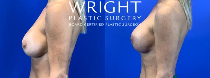 Before & After Breast Lift Case 67 Left Side View in Little Rock, Arkansas