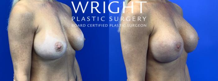 Before & After Breast Implant Exchange Case 67 Right Oblique View in Little Rock, Arkansas