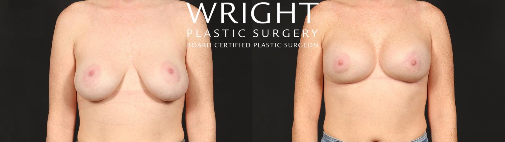Before & After Breast Implant Exchange Case 679 Front View in Little Rock, Arkansas