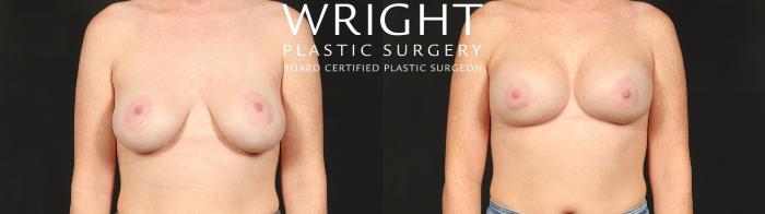 Before & After Breast Implant Exchange Case 679 Front View in Little Rock, Arkansas
