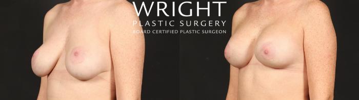 Before & After Breast Implant Exchange Case 679 Left Oblique View in Little Rock, Arkansas