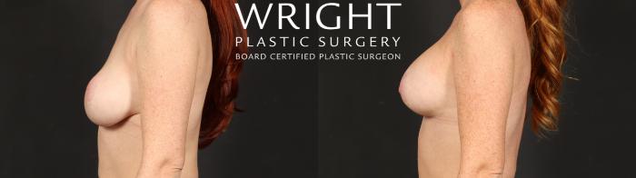 Before & After Breast Implant Exchange Case 679 Left Side View in Little Rock, Arkansas