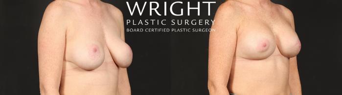 Before & After Breast Implant Exchange Case 679 Right Oblique View in Little Rock, Arkansas