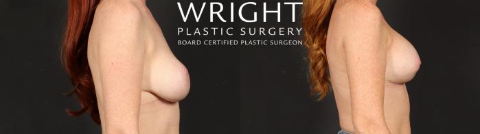 Before & After Breast Implant Exchange Case 679 Right Side View in Little Rock, Arkansas