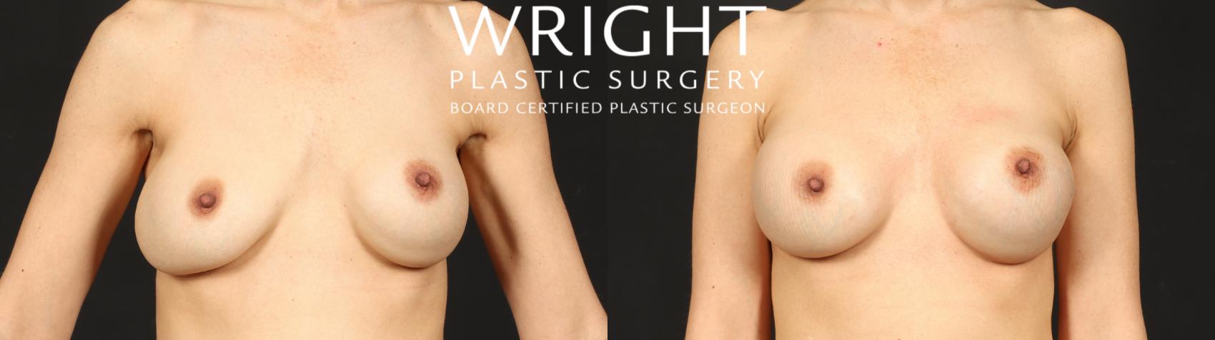Before & After Breast Implant Exchange Case 680 Front View in Little Rock, Arkansas
