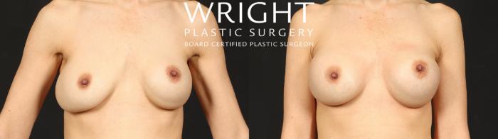 Before & After Internal Bra (Mesh) Case 680 Front View in Little Rock, Arkansas