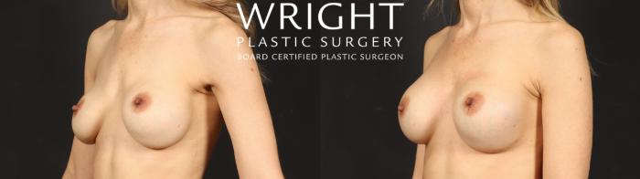 Before & After Breast Implant Exchange Case 680 Left Oblique View in Little Rock, Arkansas