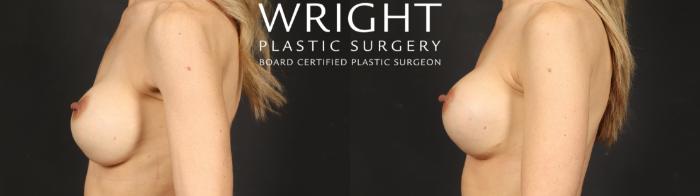 Before & After Breast Implant Exchange Case 680 Left Side View in Little Rock, Arkansas
