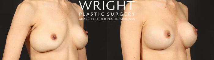 Before & After Breast Implant Exchange Case 680 Right Oblique View in Little Rock, Arkansas