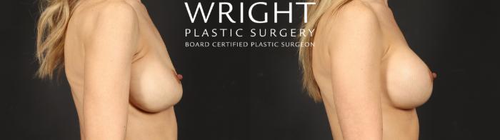 Before & After Breast Implant Exchange Case 680 Right Side View in Little Rock, Arkansas