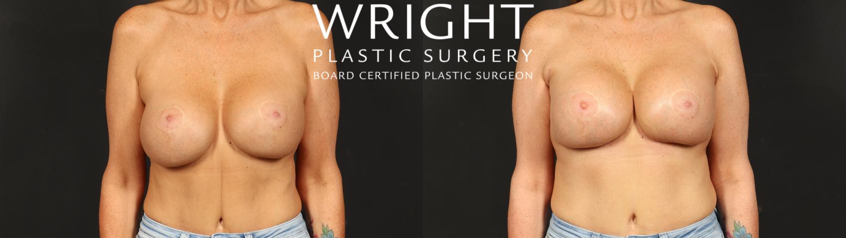 Before & After Breast Implant Exchange Case 692 Front View in Little Rock, Arkansas
