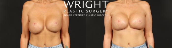 Before & After Internal Bra (Mesh) Case 692 Front View in Little Rock, Arkansas