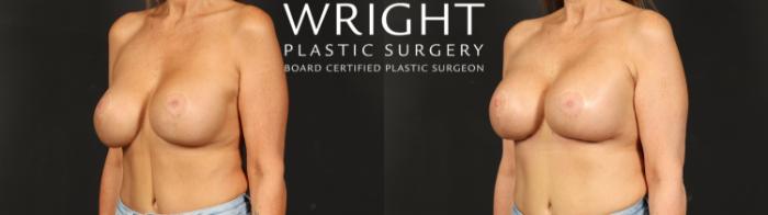 Before & After Breast Implant Exchange Case 692 Left Oblique View in Little Rock, Arkansas