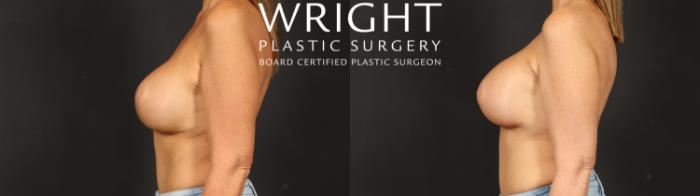 Before & After Breast Implant Exchange Case 692 Left Side View in Little Rock, Arkansas