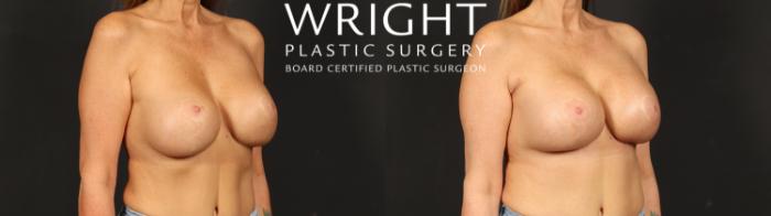 Before & After Breast Implant Exchange Case 692 Right Oblique View in Little Rock, Arkansas