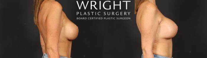 Before & After Breast Implant Exchange Case 692 Right Side View in Little Rock, Arkansas