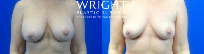 Before & After Breast Implant Removal Case 10 Front View in Little Rock, Arkansas