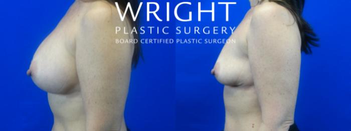 Before & After Breast Implant Removal Case 10 Left Side View in Little Rock, Arkansas