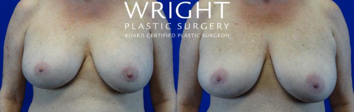 Before & After Breast Implant Removal Case 11 Front View in Little Rock, Arkansas