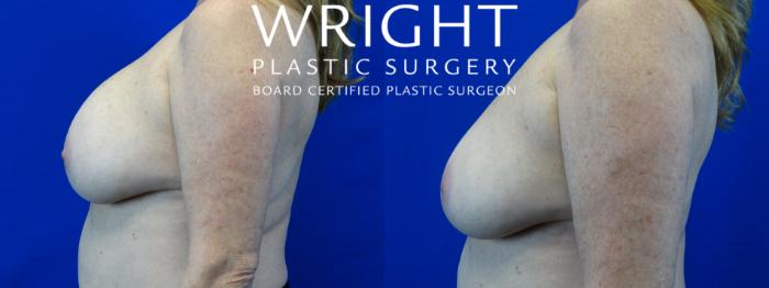 Before & After Breast Implant Removal Case 11 Left Side View in Little Rock, Arkansas