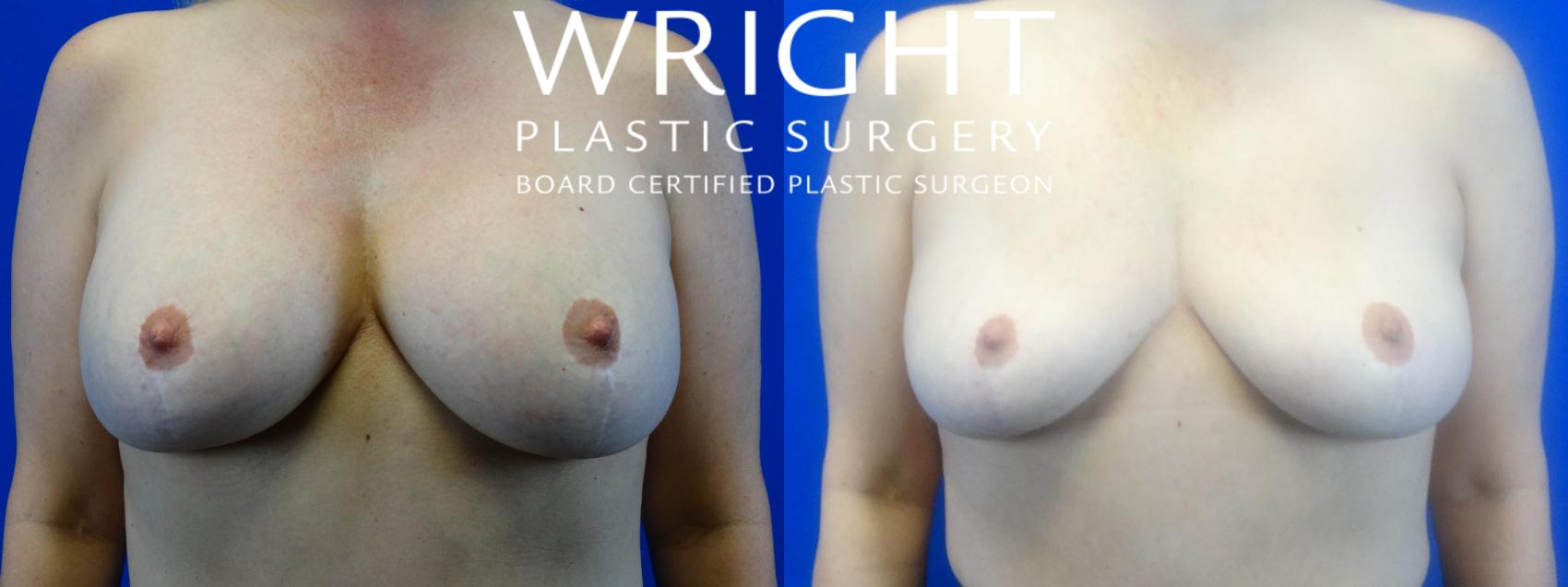 Before & After Breast Implant Removal Case 12 Front View in Little Rock, Arkansas