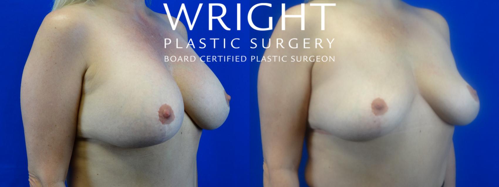 Before & After Breast Implant Removal Case 12 Right Oblique View in Little Rock, Arkansas
