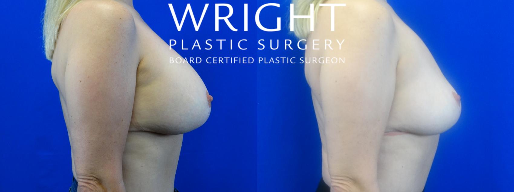 Before & After Breast Implant Removal Case 12 Right Side View in Little Rock, Arkansas