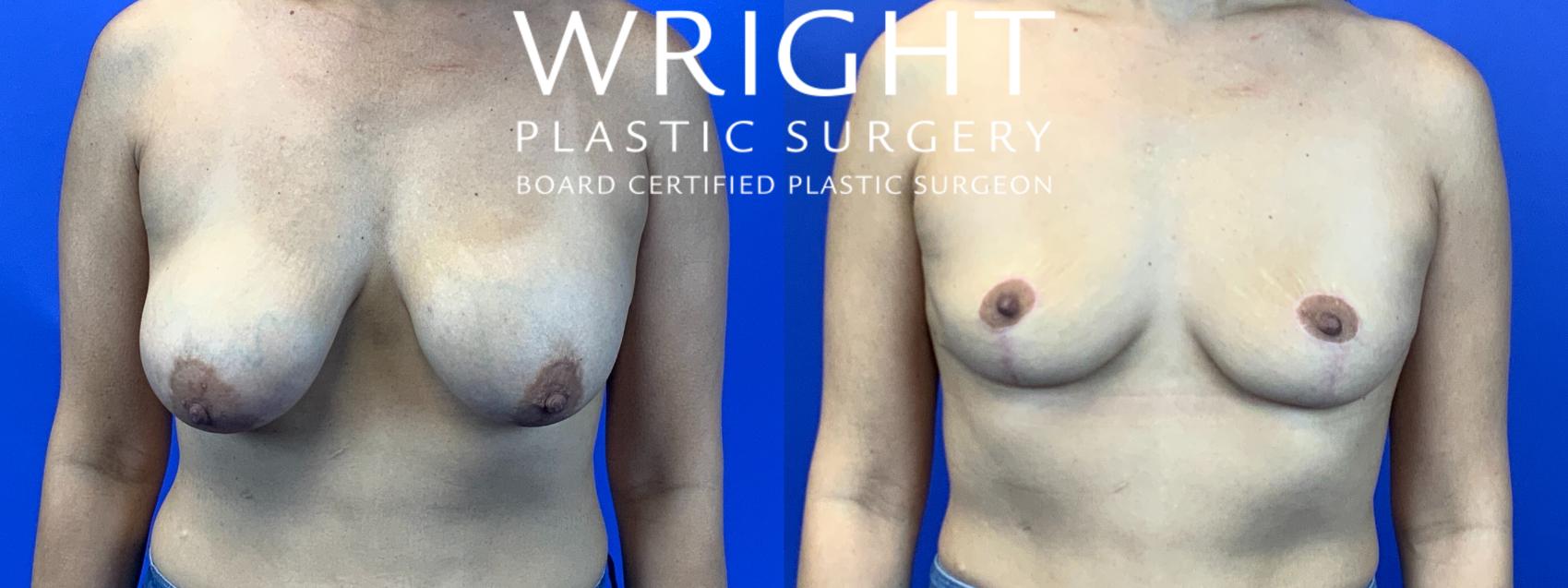Before & After Breast Lift Case 123 Front View in Little Rock, Arkansas