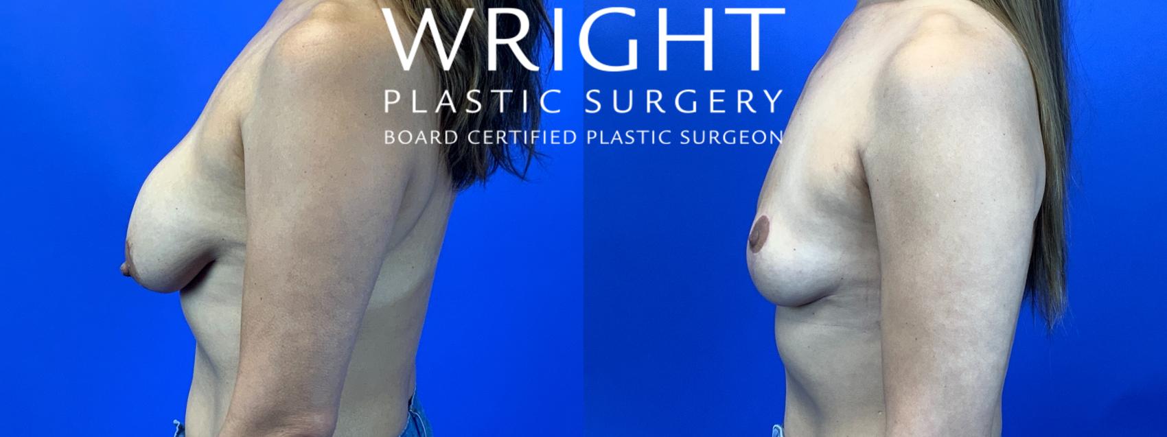 Before & After Breast Implant Removal Case 123 Left Side View in Little Rock, Arkansas