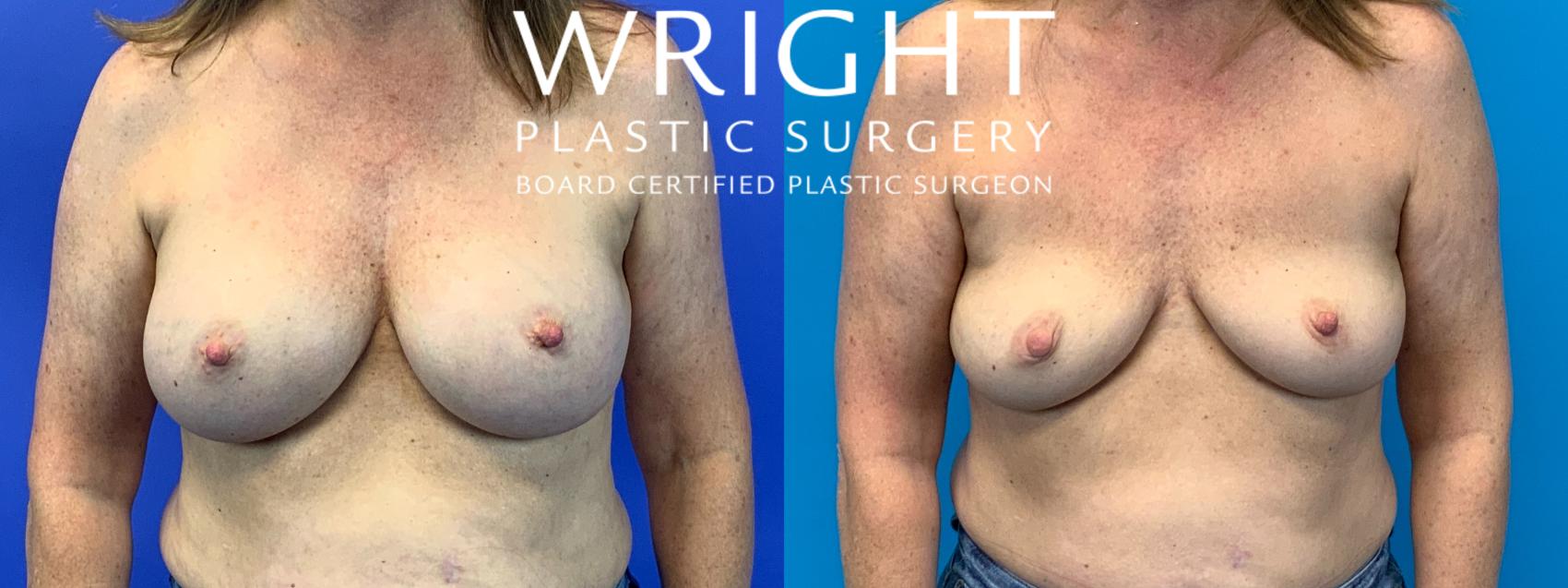 Before & After Breast Implant Removal Case 154 Front View in Little Rock, Arkansas