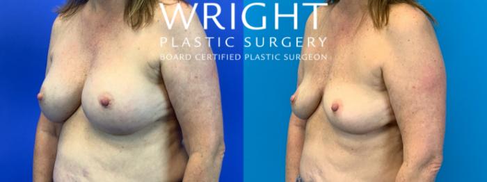 Before & After Breast Implant Removal Case 154 Left Oblique View in Little Rock, Arkansas