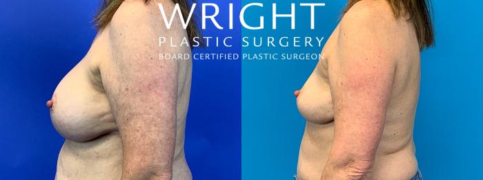 Before & After Breast Implant Removal Case 154 Left Side View in Little Rock, Arkansas