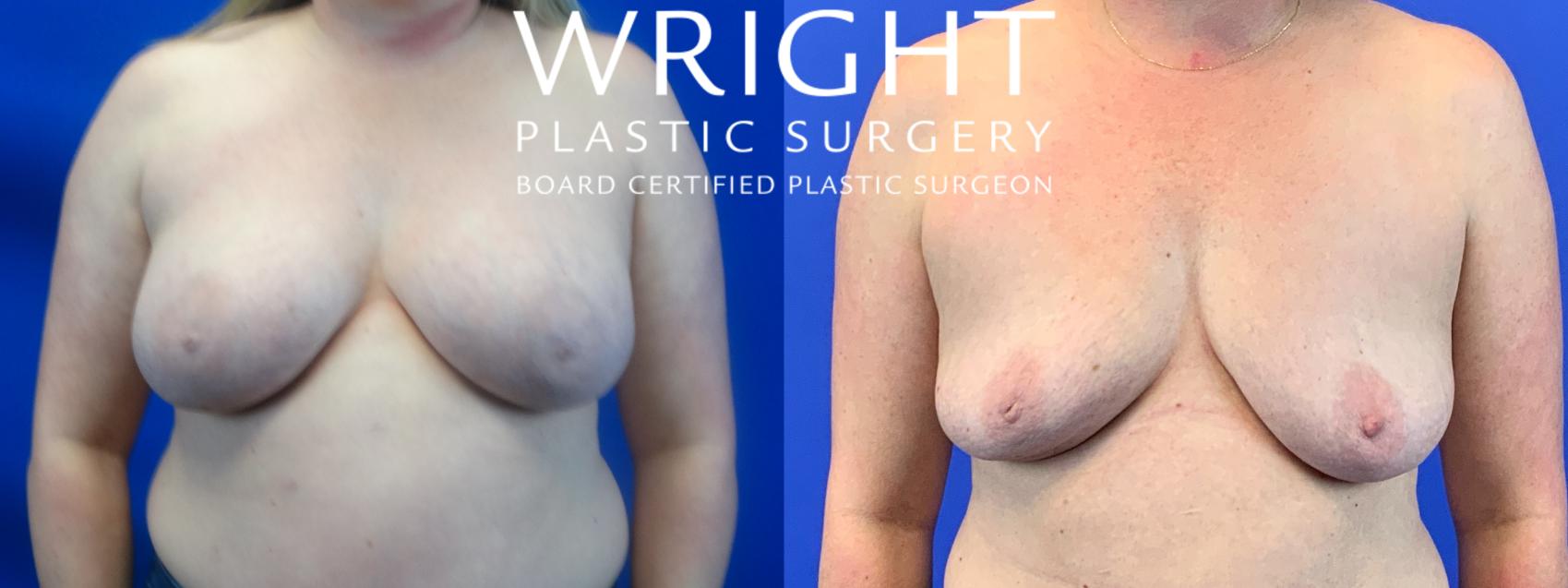 Before & After Breast Implant Removal Case 157 Front View in Little Rock, Arkansas
