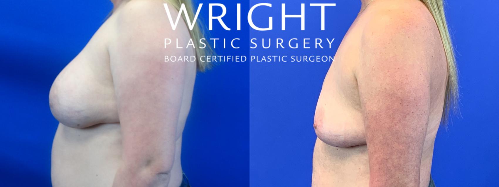 Before & After Breast Implant Removal Case 157 Left Side View in Little Rock, Arkansas