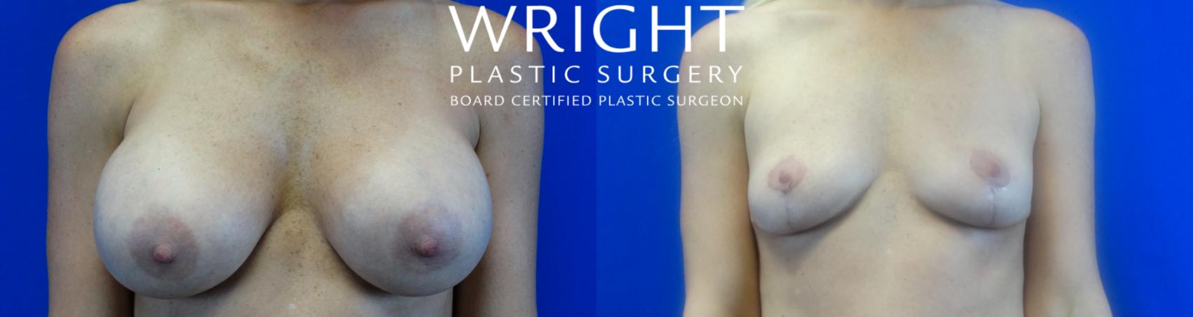 Before & After Breast Implant Removal Case 16 Front View in Little Rock, Arkansas